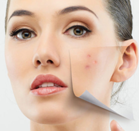 Divine Clinic | Acne